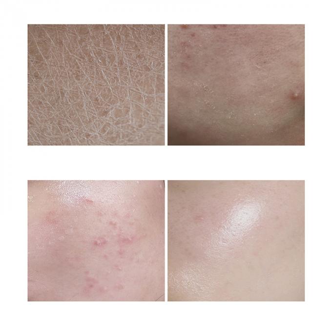 30ml本質の表面血清100%の純粋な赤みの放射皮高度のRosacea 1