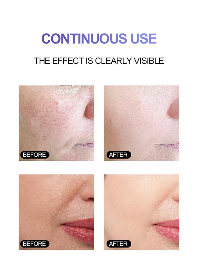30ml本質の表面血清100%の純粋な赤みの放射皮高度のRosacea 1