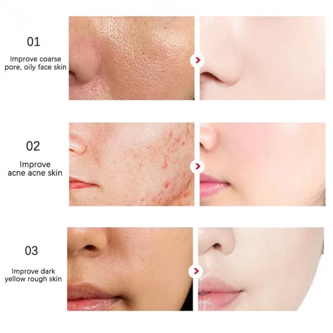 30ml本質の表面血清100%の純粋な赤みの放射皮高度のRosacea 1