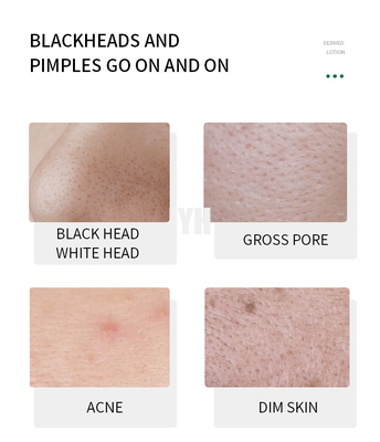 Lackheadを得た本質の表面血清のBlackheadの除去剤の血清を柔らかくしなさい